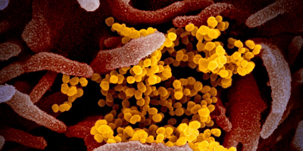 SARS-CoV-2 virus particles through a scanning electron microscope