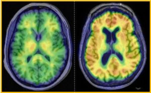PET scans of brain amyloid levels