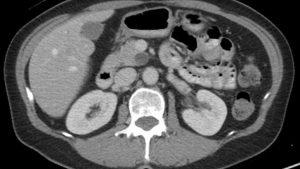 Medical image of pancreatic cyst.